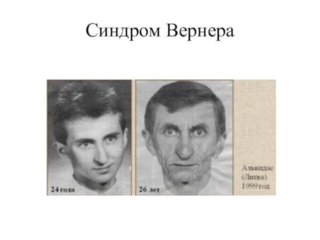 Синдром Вернера