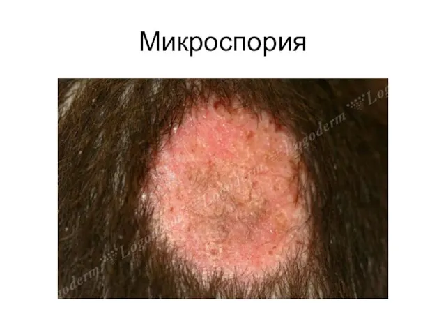 Микроспория