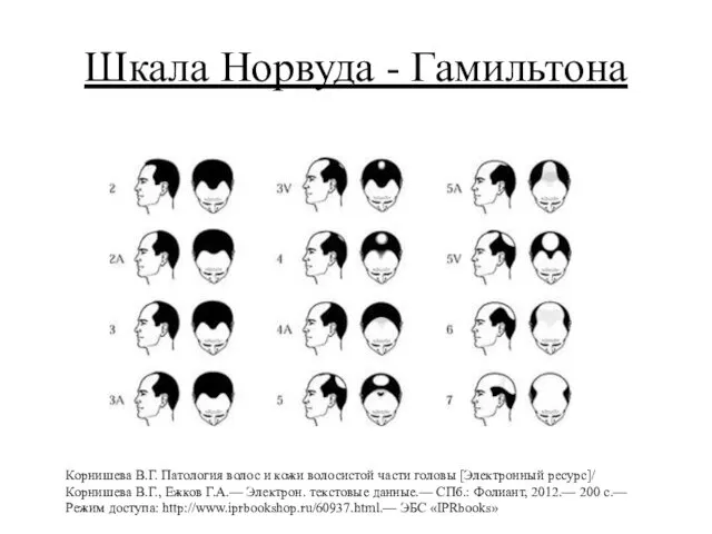 Шкала Норвуда - Гамильтона Корнишева В.Г. Патология волос и кожи волосистой