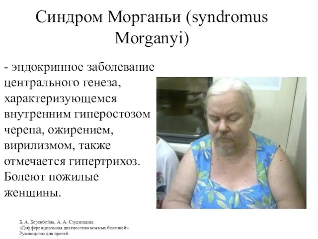 Синдром Морганьи (syndromus Morganyi) - эндокринное заболевание центрального генеза, характеризующемся внутренним