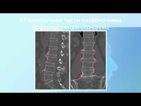 КТ поясничной части позвоночника Деформирующий спондилез