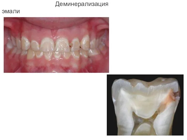 Деминерализация эмали