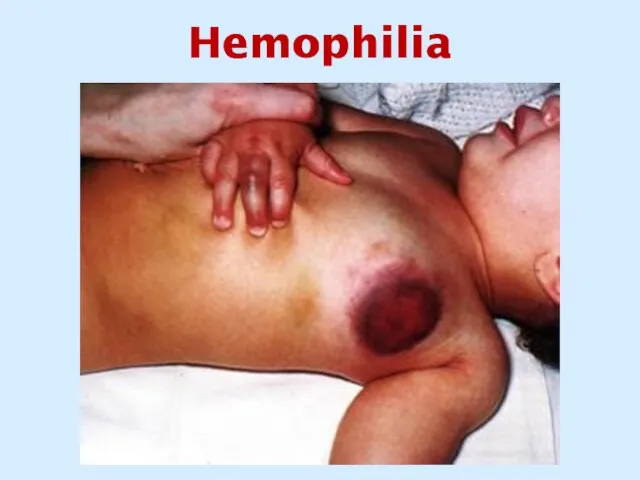 Hemophilia