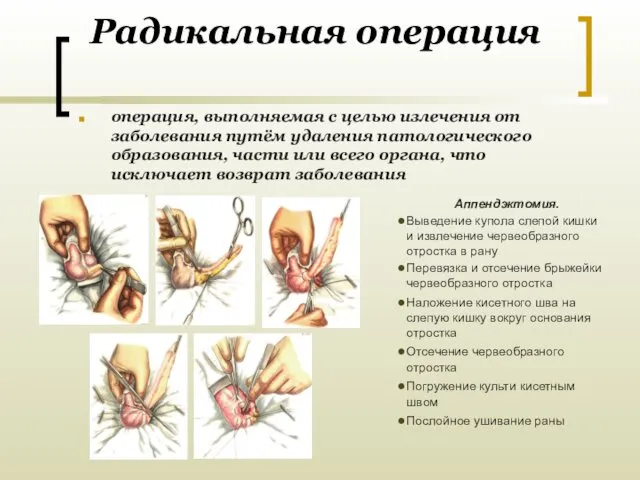 Радикальная операция операция, выполняемая с целью излечения от заболевания путём удаления