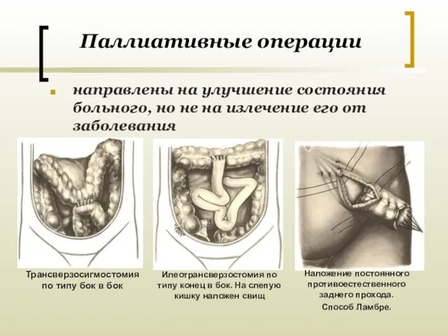 Паллиативные операции направлены на улучшение состояния больного, но не на излечение