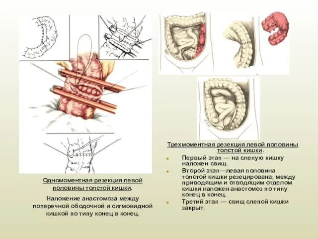 Одномоментная резекция левой половины толстой кишки. Наложение анастомоза между поперечной ободочной