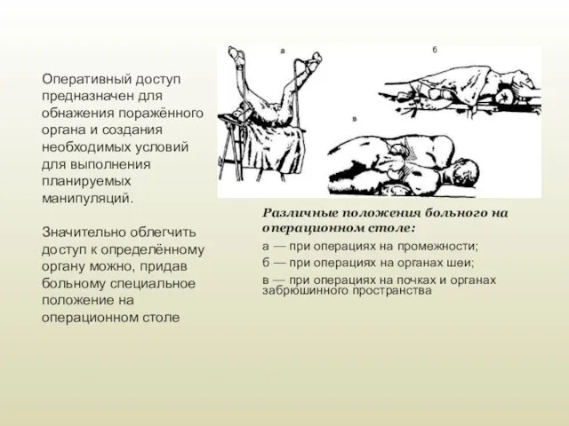 Различные положения больного на операционном столе: а — при операциях на