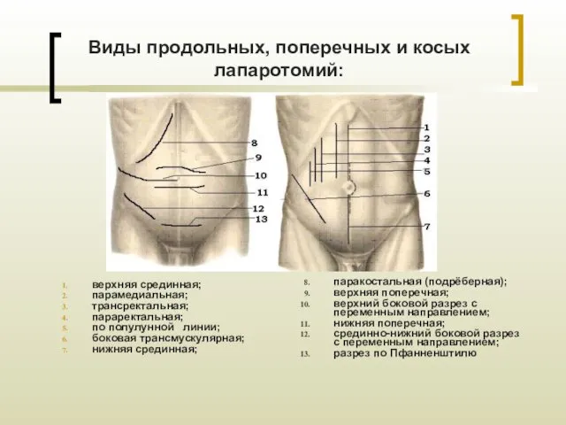 Виды продольных, поперечных и косых лапаротомий: верхняя срединная; парамедиальная; трансректальная; параректальная;