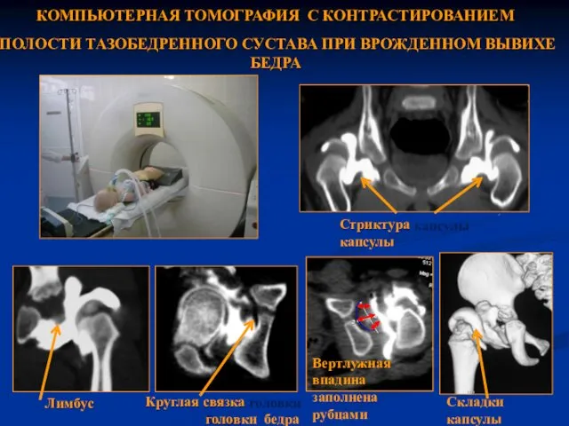 КОМПЬЮТЕРНАЯ ТОМОГРАФИЯ С КОНТРАСТИРОВАНИЕМ ПОЛОСТИ ТАЗОБЕДРЕННОГО СУСТАВА ПРИ ВРОЖДЕННОМ ВЫВИХЕ БЕДРА