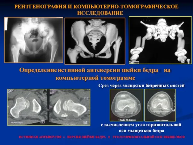 ИСТИННАЯ АНТЕВЕРСИЯ = ВЕРСИЯ ШЕЙКИ БЕДРА ± УГОЛ ГОРИЗОНТАЛЬНОЙ ОСИ МЫЩЕЛКОВ