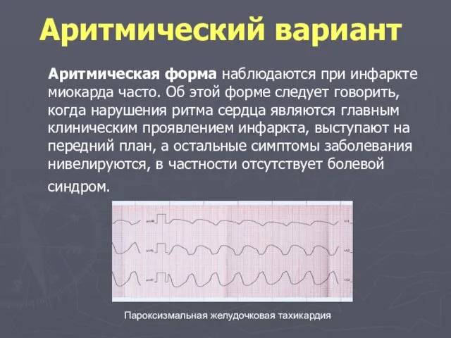 Аритмический вариант Аритмическая форма наблюдаются при инфаркте миокарда часто. Об этой