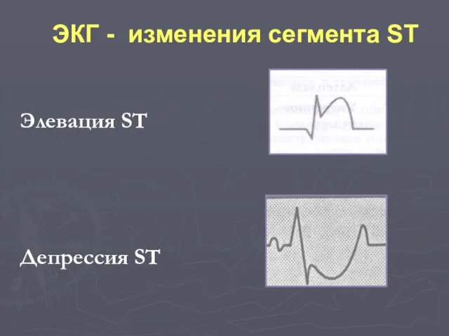 Элевация ST Депрессия ST ЭКГ - изменения сегмента ST