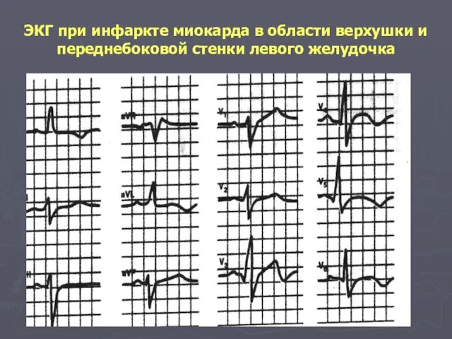 ЭКГ при инфаркте миокарда в области верхушки и переднебоковой стенки левого желудочка