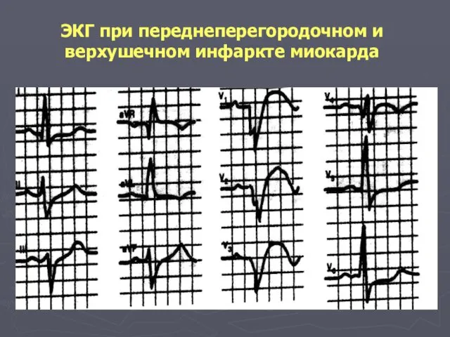 ЭКГ при переднеперегородочном и верхушечном инфаркте миокарда