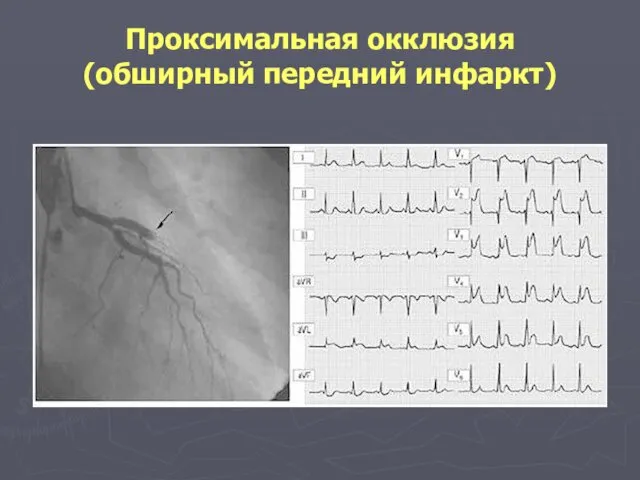 Проксимальная окклюзия (обширный передний инфаркт)