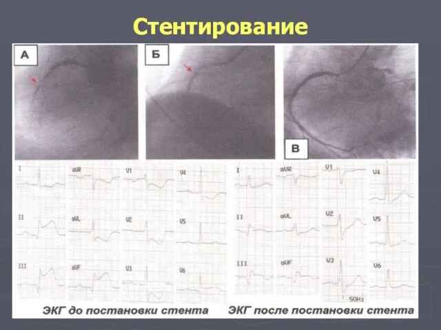 Стентирование