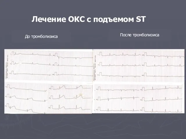 Лечение ОКС с подъемом ST До тромболизиса После тромболизиса