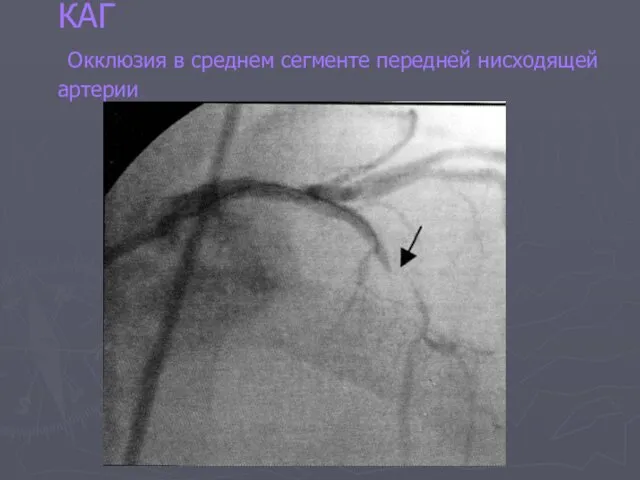 КАГ Окклюзия в среднем сегменте передней нисходящей артерии