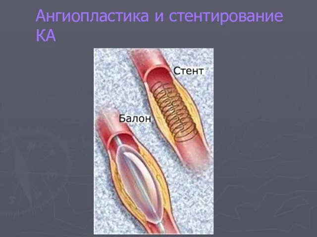 Ангиопластика и стентирование КА