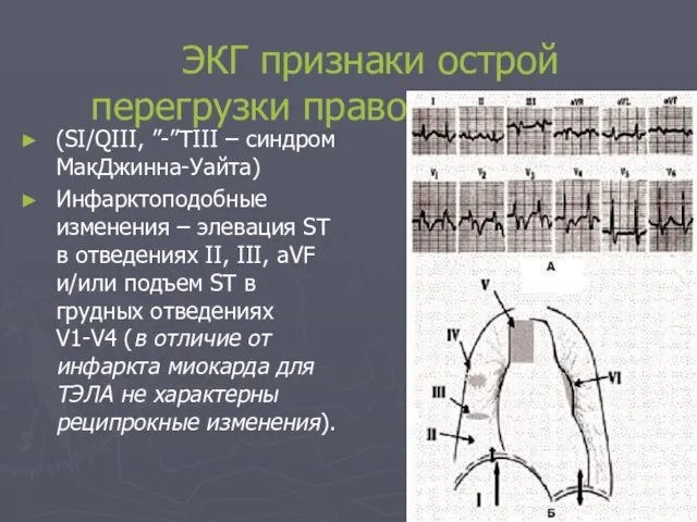 ЭКГ признаки острой перегрузки правого желудочка (SI/QIII, ”-”TIII – синдром МакДжинна-Уайта)