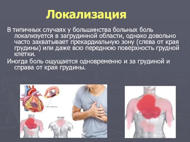 Локализация В типичных случаях у большинства больных боль локализуется в загрудинной