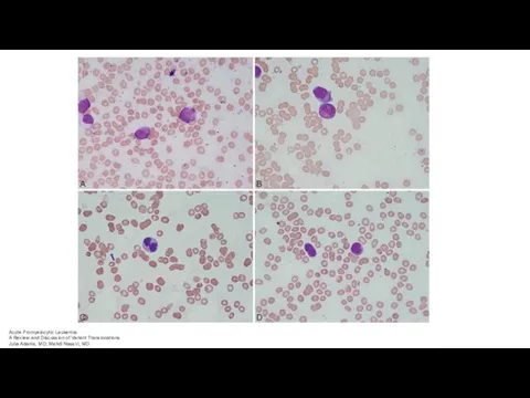 Acute Promyelocytic Leukemia A Review and Discussion of Variant Translocations Julia Adams, MD; Mehdi Nassiri, MD