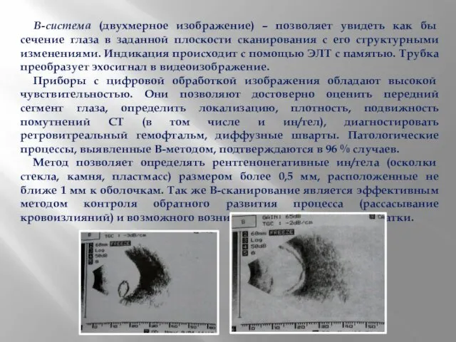 В-система (двухмерное изображение) – позволяет увидеть как бы сечение глаза в