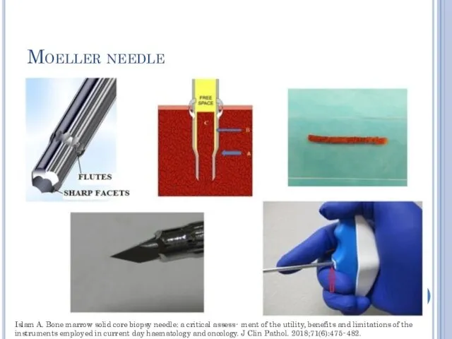 Moeller needle Islam A. Bone marrow solid core biopsy needle: a