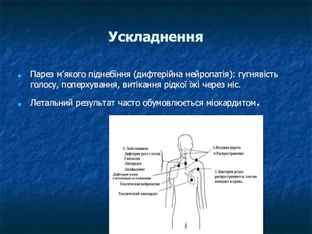 Ускладнення Парез м’якого піднебіння (дифтерійна нейропатія): гугнявість голосу, поперхування, витікання рідкої