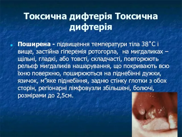 Токсична дифтерія Токсична дифтерія Поширена - підвищення температури тіла 38˚С і