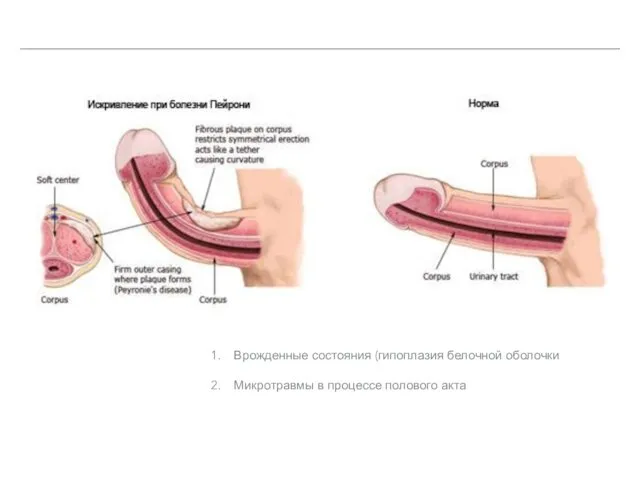 Врожденные состояния (гипоплазия белочной оболочки Микротравмы в процессе полового акта
