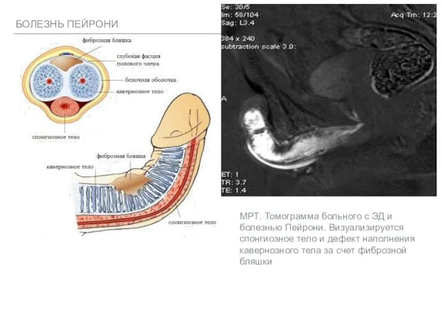 БОЛЕЗНЬ ПЕЙРОНИ МРТ. Томограмма больного с ЭД и болезнью Пейрони. Визуализируется