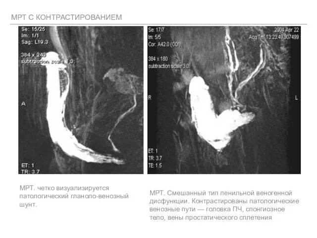 МРТ С КОНТРАСТИРОВАНИЕМ МРТ. Смешанный тип пенильной веногенной дисфункции. Контрастированы патологические