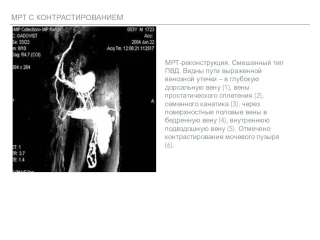 МРТ С КОНТРАСТИРОВАНИЕМ МРТ-реконструкция. Смешанный тип ПВД. Видны пути выраженной венозной