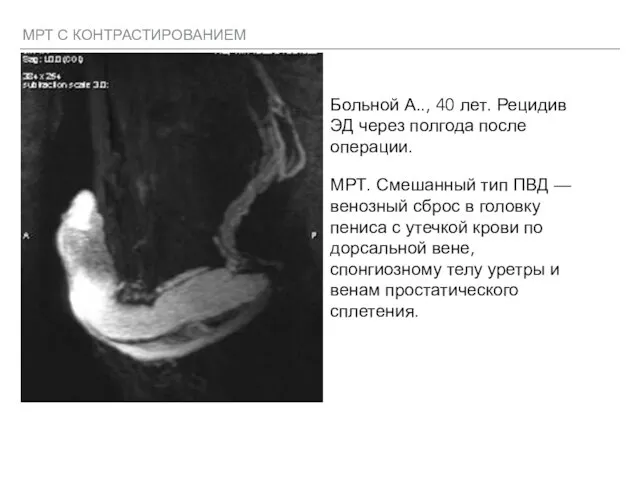 МРТ С КОНТРАСТИРОВАНИЕМ Больной А.., 40 лет. Рецидив ЭД через полгода