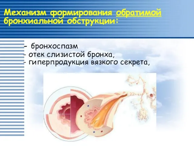 Механизм формирования обратимой бронхиальной обструкции: - бронхоспазм - отек слизистой бронха, - гиперпродукция вязкого секрета,