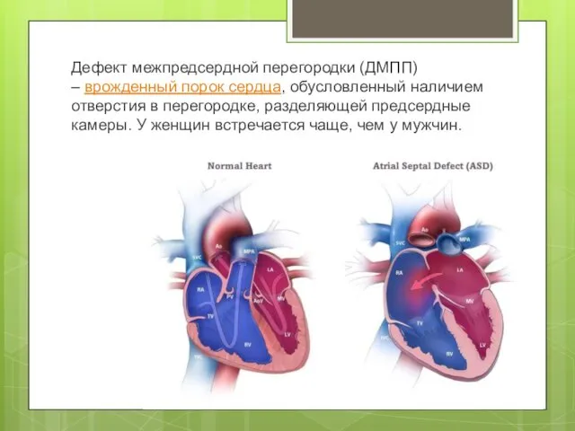 Дефект межпредсердной перегородки (ДМПП) – врожденный порок сердца, обусловленный наличием отверстия