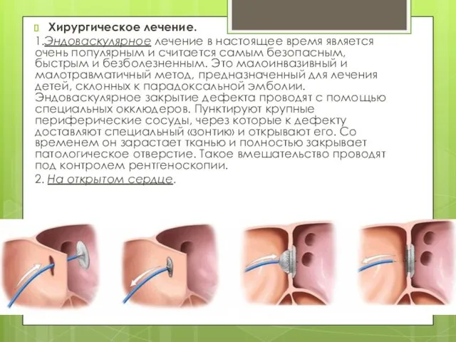 Хирургическое лечение. 1.Эндоваскулярное лечение в настоящее время является очень популярным и