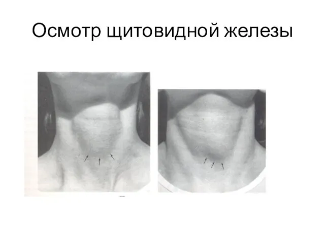 Осмотр щитовидной железы