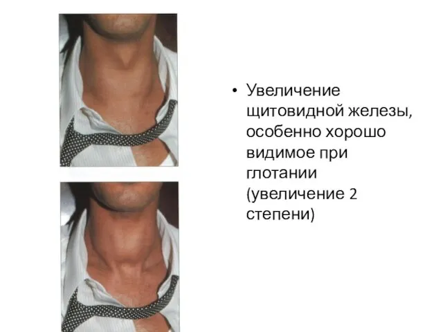 Увеличение щитовидной железы, особенно хорошо видимое при глотании (увеличение 2 степени)