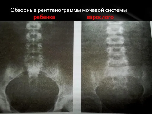 Обзорные рентгенограммы мочевой системы ребенка взрослого