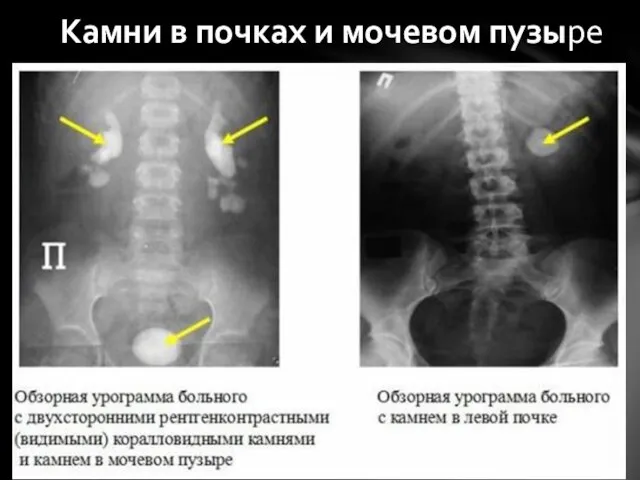 Камни в почках и мочевом пузыре