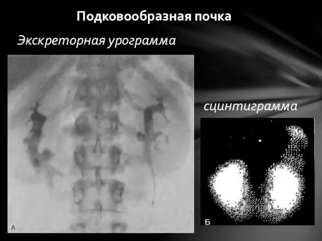 Экскреторная урограмма сцинтиграмма Подковообразная почка