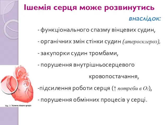 Ішемія серця може розвинутись внаслідок: функціонального спазму вінцевих судин, органічних змін