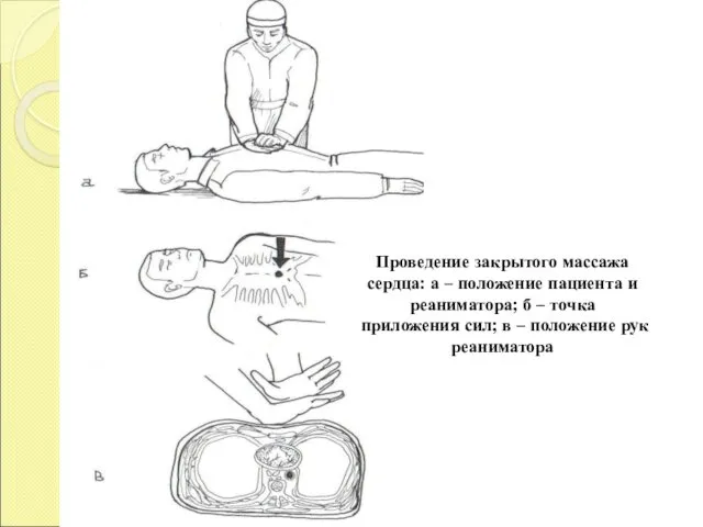 Проведение закрытого массажа сердца: а – положение пациента и реаниматора; б