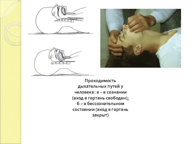 Проходимость дыхательных путей у человека: а – в сознании (вход в