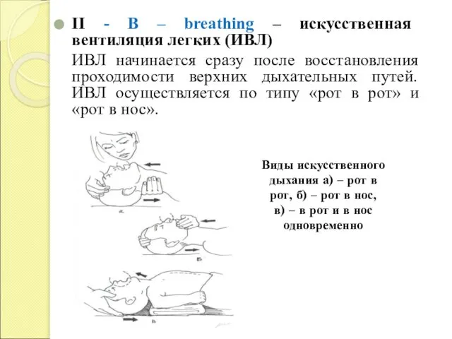 II - B – breathing – искусственная вентиляция легких (ИВЛ) ИВЛ