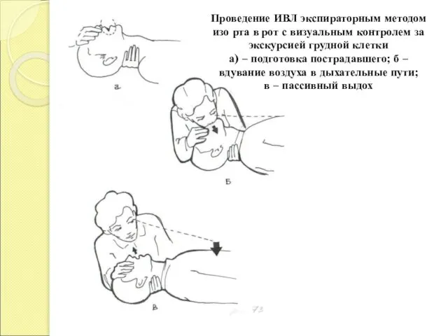 Проведение ИВЛ экспираторным методом изо рта в рот с визуальным контролем