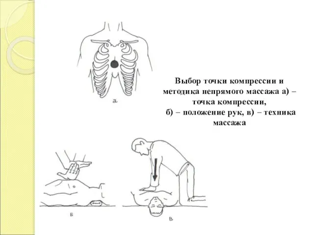 Выбор точки компрессии и методика непрямого массажа а) – точка компрессии,