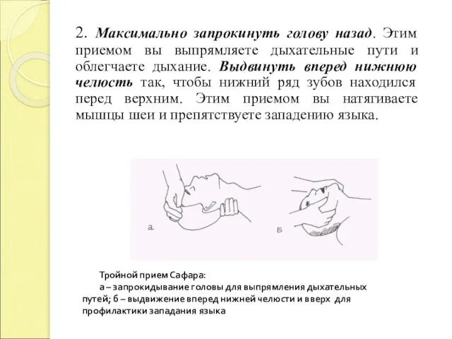 2. Максимально запрокинуть голову назад. Этим приемом вы выпрямляете дыхательные пути